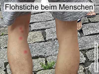Flohstiche-Mensch Bilder Flohstiche beim Menschen