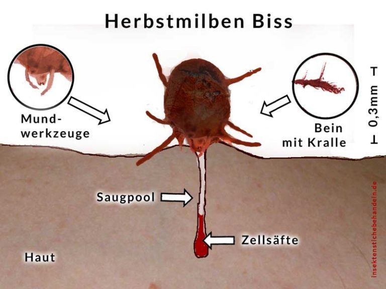 Wunderschöne Grasmilben Bisse Behandeln Bilder